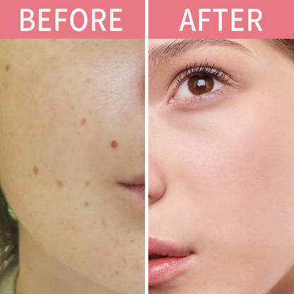 Timilk Wart & Mole Removal Spray
