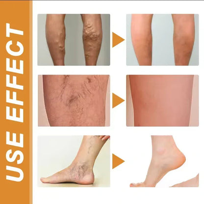 Turmeric Vericose Vein Relief Spray ( Imported )