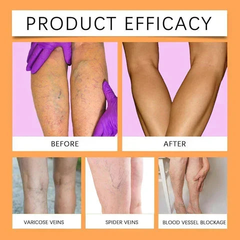 Turmeric Vericose Vein Relief Spray ( Imported )