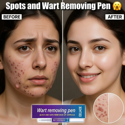 Warts, Moles & Skin Tag Remover Pen