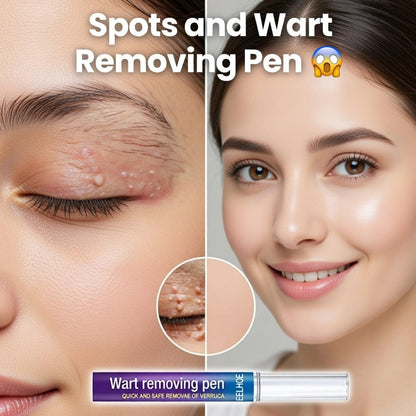 Warts, Moles & Skin Tag Remover Pen