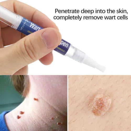 Warts, Moles & Skin Tag Remover Pen